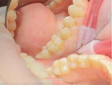 tratamentul cariilor cu laserul dentar